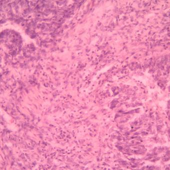 Mostres d’un tumor de fetge vistes gràcies a la nova plataforma Unique CaixaResearch. © VHIO.