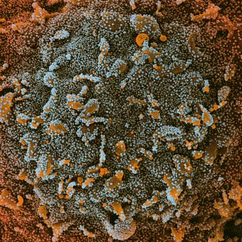 Micrografia electrònica de rastreig (MER) en color d’una cèl·lula infectada amb partícules del virus SARS-CoV-2.