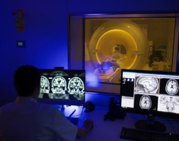 El flux sanguini del cervell disminueix en etapes asimptomàtiques de l'Alzheimer