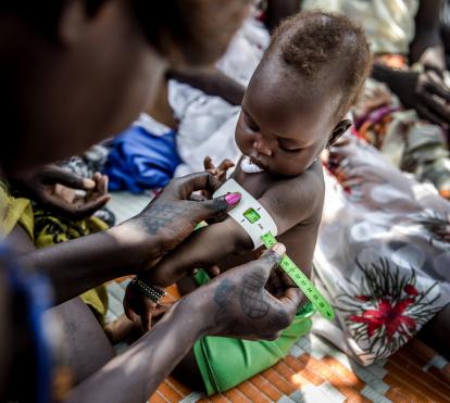 Mesurament del nivell de malnutrició d'un nen a un camp de refugiats d'Etiòpia.